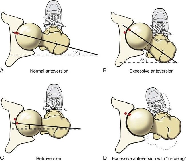 Hip socket angle: anteversion makes for deeper squats, retroversion makes it harder to hit depth.