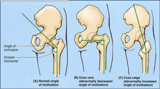 Femoral neck angle.